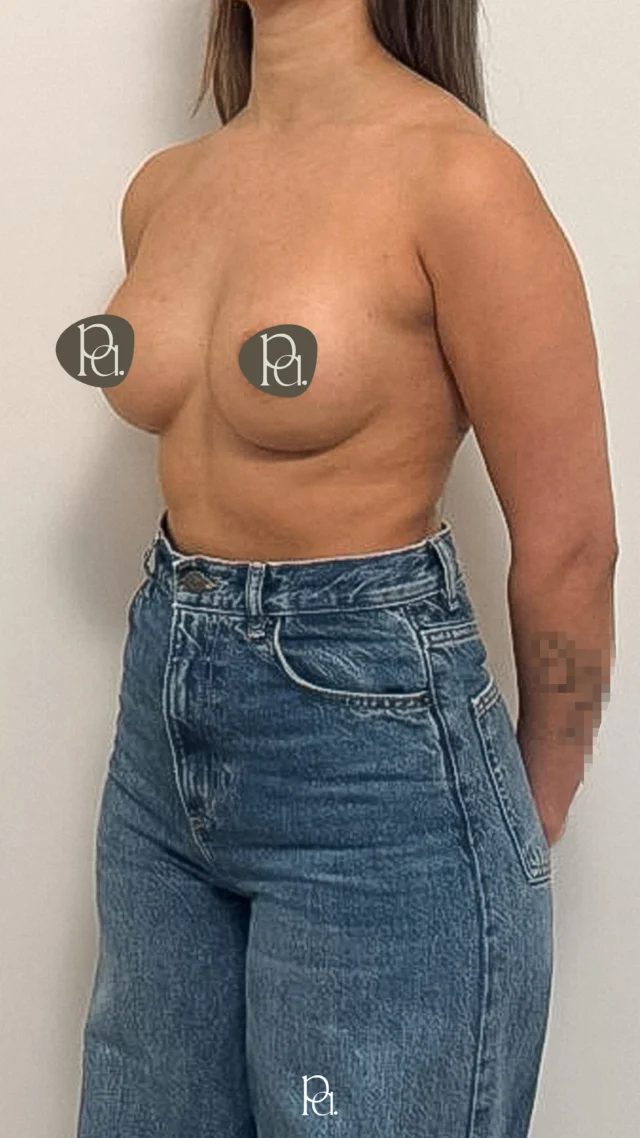Breast by @doc.bertrams

Langzeitergebnis nach 2,5 Jahren – stabile Schönheit
Heute zeigen wir euch das Ergebnis einer Brustvergrößerung mit 285 ml Implantaten in Demiprojektion – komplett submuskulär eingesetzt. Die Patientin kam nach zweieinhalb Jahren erneut in unsere Praxis – aus einem anderen Grund, aber mit derselben Begeisterung für ihr Ergebnis:

Keine Beschwerden. Natürliche Form. Anhaltende Zufriedenheit.

Ein schöner Beweis dafür, wie harmonisch und stabil ein Eingriff auch langfristig sein kann – bei sorgfältiger Planung, präziser OP-Technik und einem individuell passenden Implantat.

Du hast ähnliche Wünsche oder Fragen?
Dann schreib uns gerne – unsere Kontaktdaten findest du unten.

👉 Jetzt Termin vereinbaren: Link in unserer Bio.

📍 PA_Pure Aesthetics GmbH
Kolumbastraße 10, 50667 Köln
✉️ info@pa-pure.com
📞 +49 (0)221 2921760
🌐 pa-pure.com

#pureaesthetics #docbertrams  #whatmatterstoyou